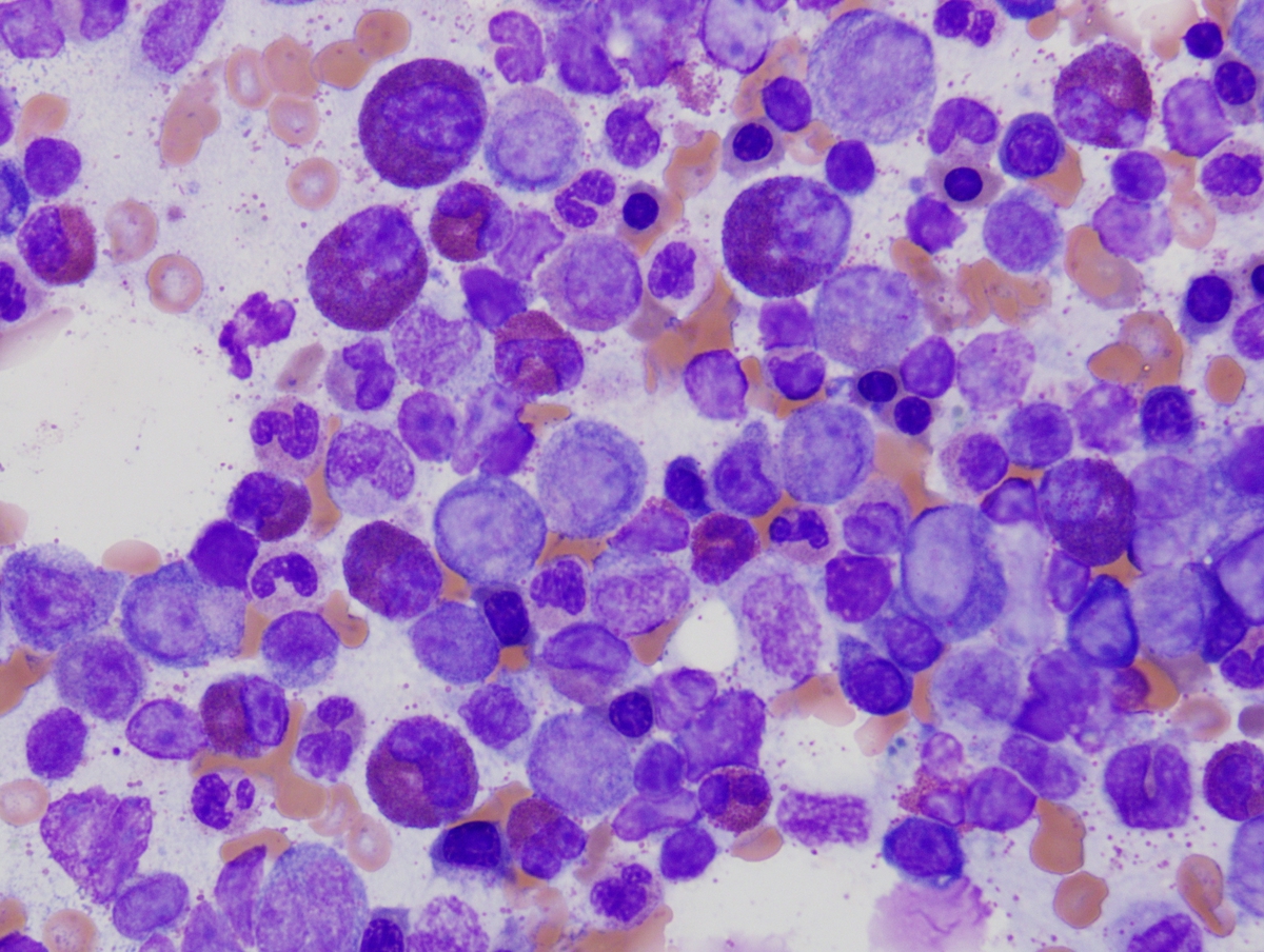 Bone marrow aspirate (BM3) demonstrating profound eosinophilia and myeloid hyperplasia (Wright Giesma, 40x).